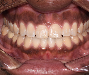 Amityville Emergency Dentist