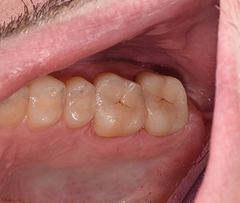 Family Dentist in Amityville