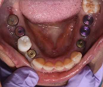 Dental Implants Dentist in Amityville