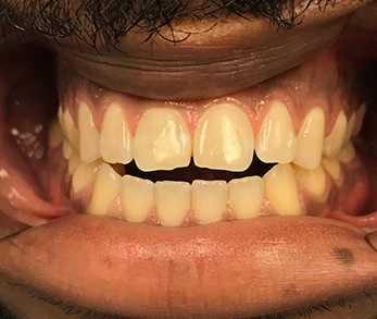 Family Dentist in Amityville