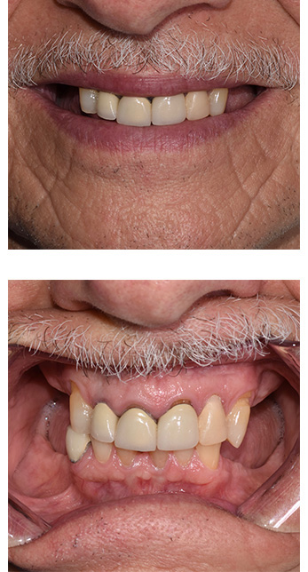 Dental Implants Dentist in Amityville