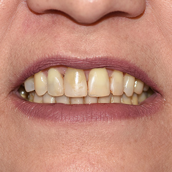 Amity Harbor Dentistry | LANAP reg , Emergency Treatment and Implant Dentistry